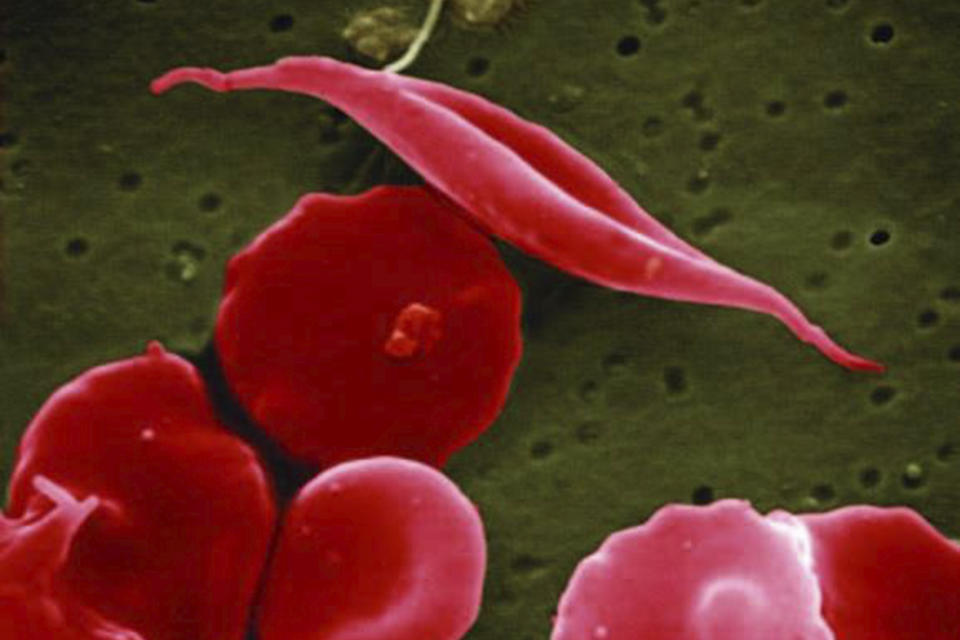 This electron microscope image provided by the National Institutes of Health in 2016 shows a blood cell altered by sickle cell disease, top. (National Center for Advancing Translational Sciences (NCATS), National Institutes of Health via AP)