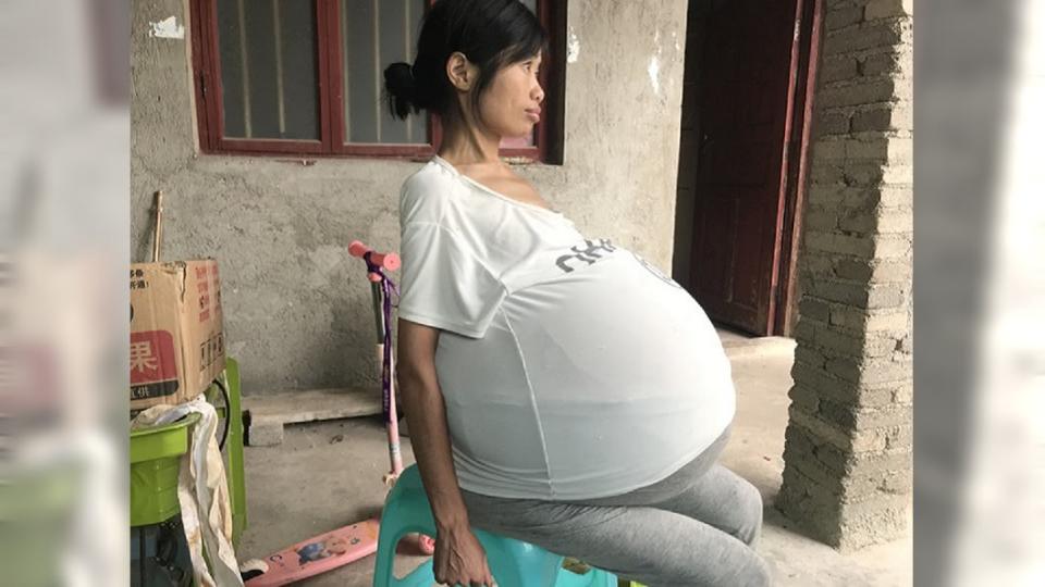貴州1名婦人明明沒懷孕，但她的肚子卻脹得比懷孕10月的孕婦還大。（圖／翻攝自貴州都市網）