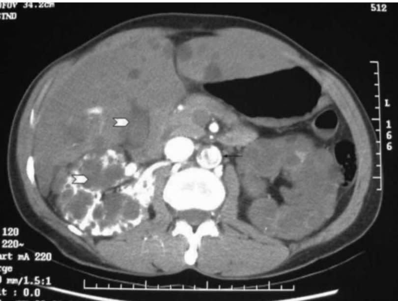 電腦斷層顯示多囊腎。（圖／李建璋臉書）