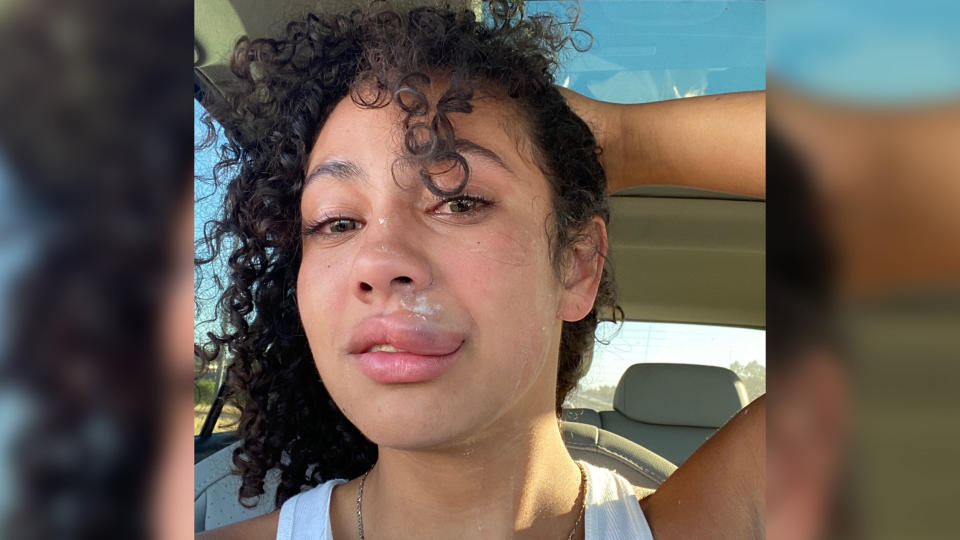 Zeelee Segura shows her rubber bullet injury soon after leaving a May 30 protest in La Mesa, California. (Photo: Courtesy of Zeelee Segura)