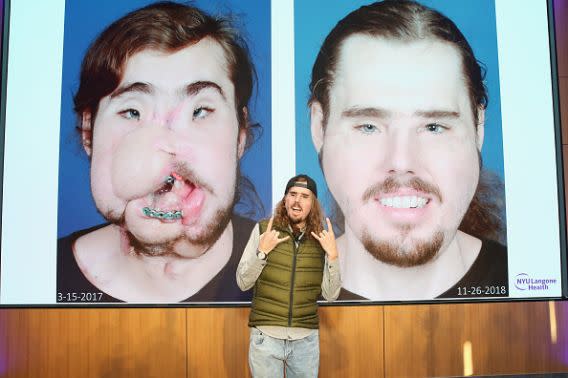 Before and after: Cam Underwood reveals his remarkable transformation at a New York press conference. (Photo by Monica Schipper/Getty Images for NYU Langone