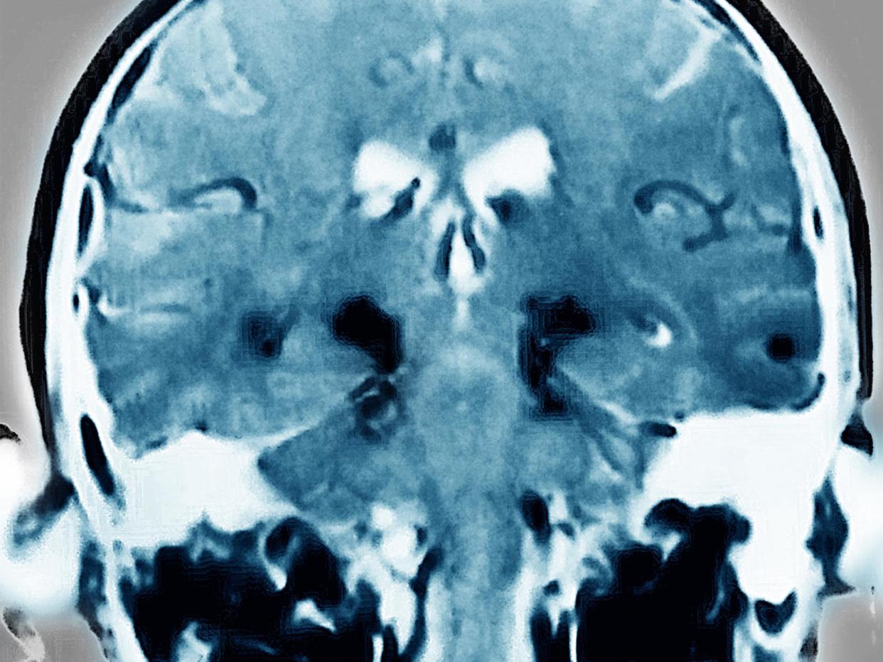 MRI scan of a Parkinson's patient: Getty