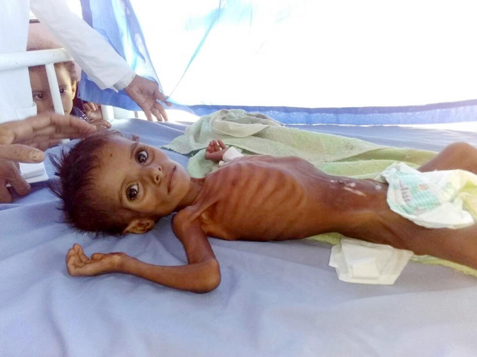 This undated 2018 handout image provided by Dr. Mekkiya Mahdi, Head of Aslam Health Center, shows a severely malnourished child at the Aslam Health Center in Hajjah, Yemen. Before the war, the health center would see one or two malnourished children a month. This year, it has seen around 700. In August 2018 alone, it received 99 cases, nearly half of them in the most severe stages, the center’s nutrition chief Khaled Hassan said. (Courtesy of Dr. Mekkiya Mahdi via AP)