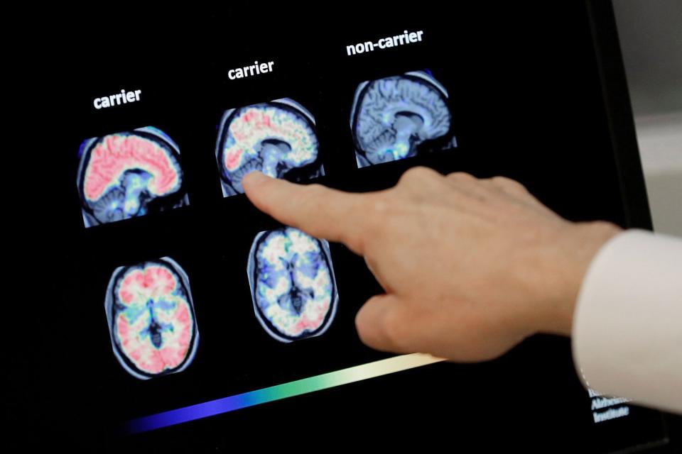 Dr. William Burke goes over a PET brain scan at Banner Alzheimers Institute in Phoenix