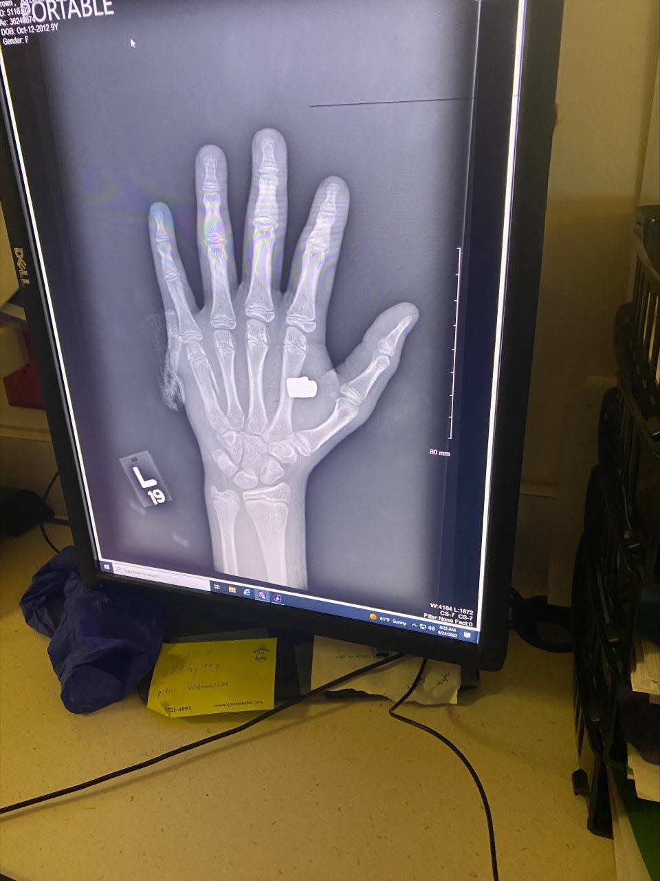 An X-ray showing the gunshot wound to Ka'leah Brown's hand in August. Brown, 9 years old at the time, was in her bed when someone fired shots into her family's home this summer. Indianapolis police said the residence was not the intended target.