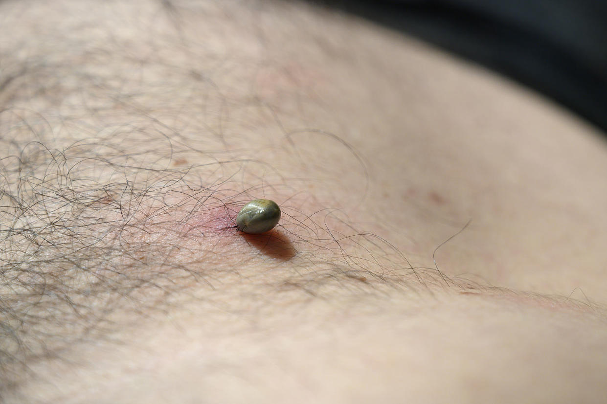 Tick ​​attached to the skin of a man's stomach and sucking blood. Germany (Aitor Diago / Getty Images)