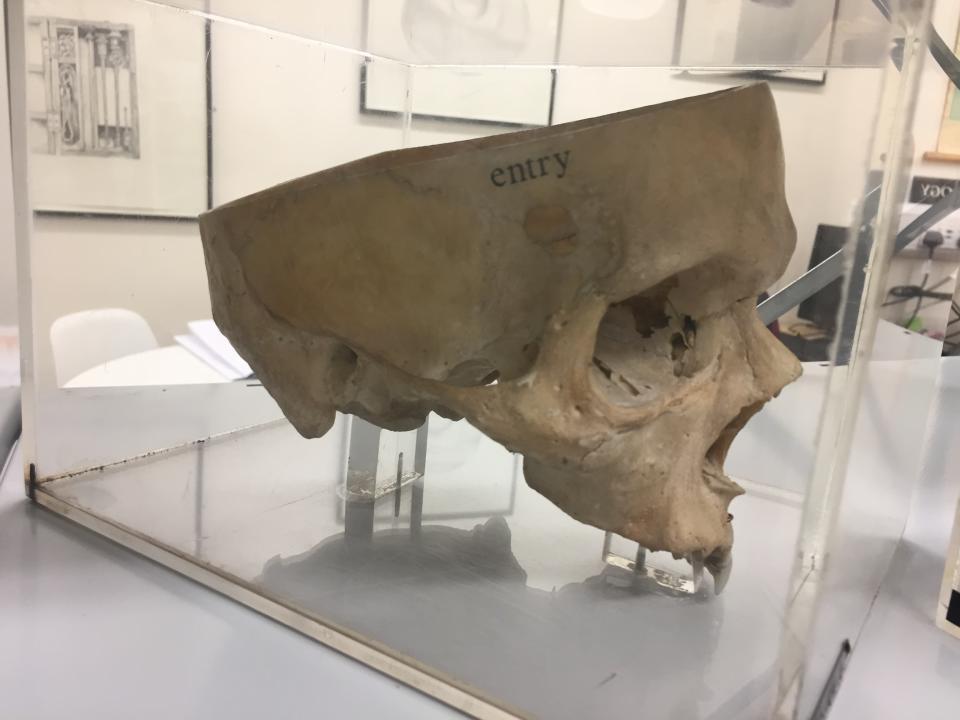 En esta muestra se presenta el cráneo de un suicida perforado por una bala de un arma de fuego.