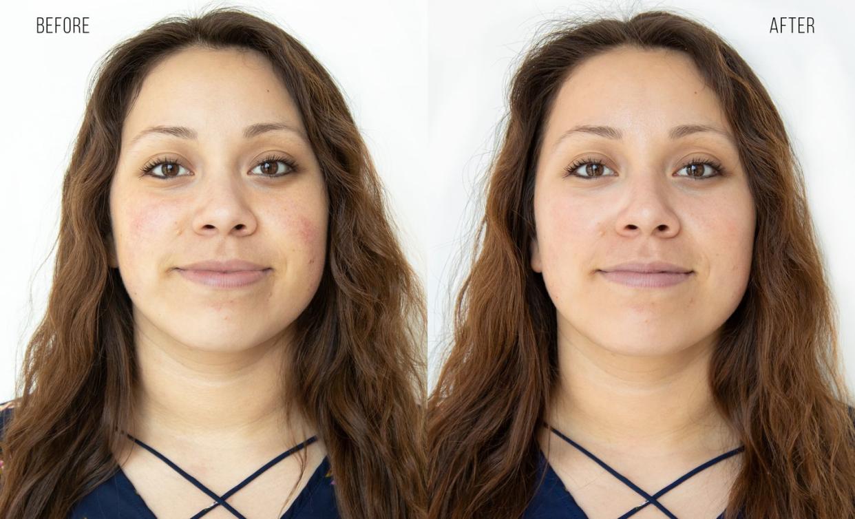 before and after image of HydraFacial 