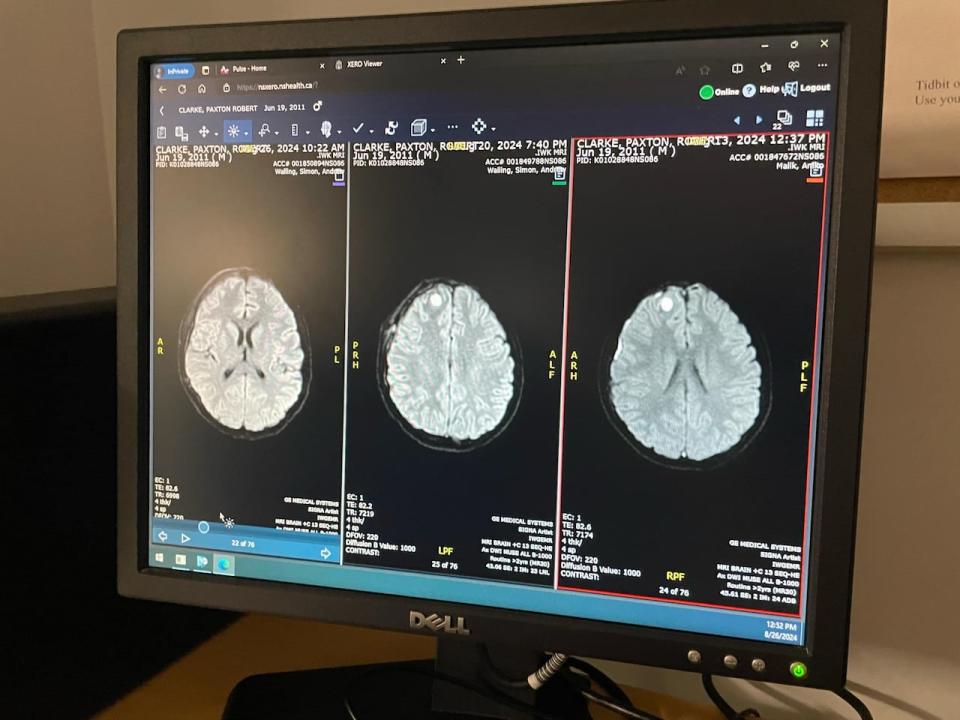 MRI scans of Paxton Clarke's brain are shown on a computer screen at the IWK in Halifax. On the far right side, a white circle is the abscess at the height of infection, along with a glowing white line at the outer edge. The middle scan followed his first surgery, while the scan on the left was taken following his second surgery and shows the abscess is gone. 