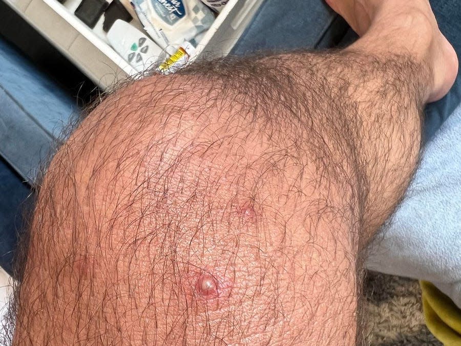 A lesion is shown on Steele's leg.