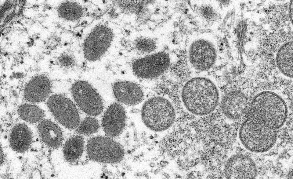 This electron microscopic (EM) image depicts monkeypox virus particles, obtained from a clinical specimen associated with the 2003 prairie dog outbreak. This is a thin section image of a specimen of human skin. On the left are oval-shaped mature virus particles, and on the right crescents and spherical particles of immature virions. (Photo by: CDC/IMAGE POINT FR/BSIP/Universal Images Group via Getty Images)