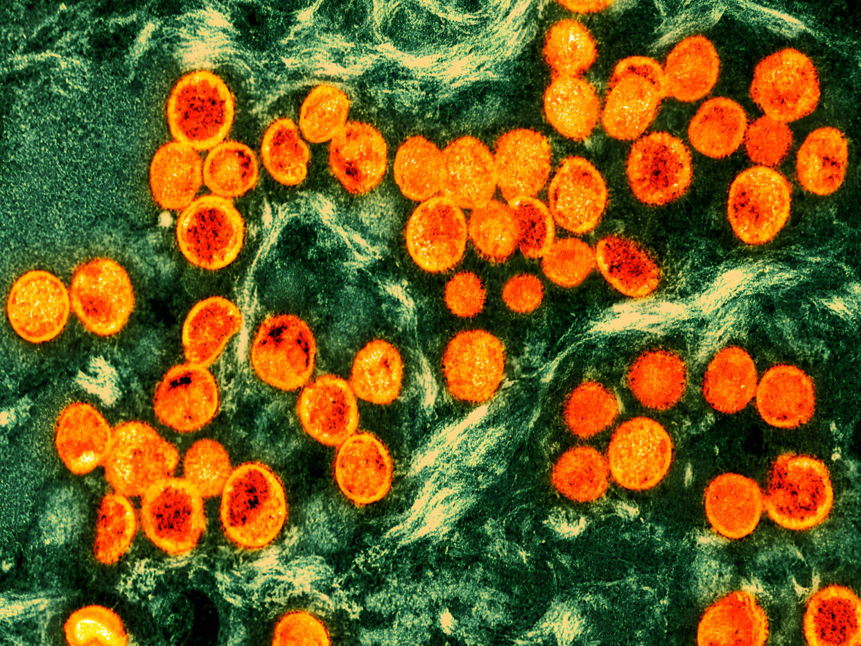 Colorized transmission electron micrograph of monkeypox virus particles (orange) found within an infected cell (green), cultured in the laboratory. (Photo by: NIH-NIAID/IMAGE POINT FR/BSIP/Universal Images Group via Getty Images)