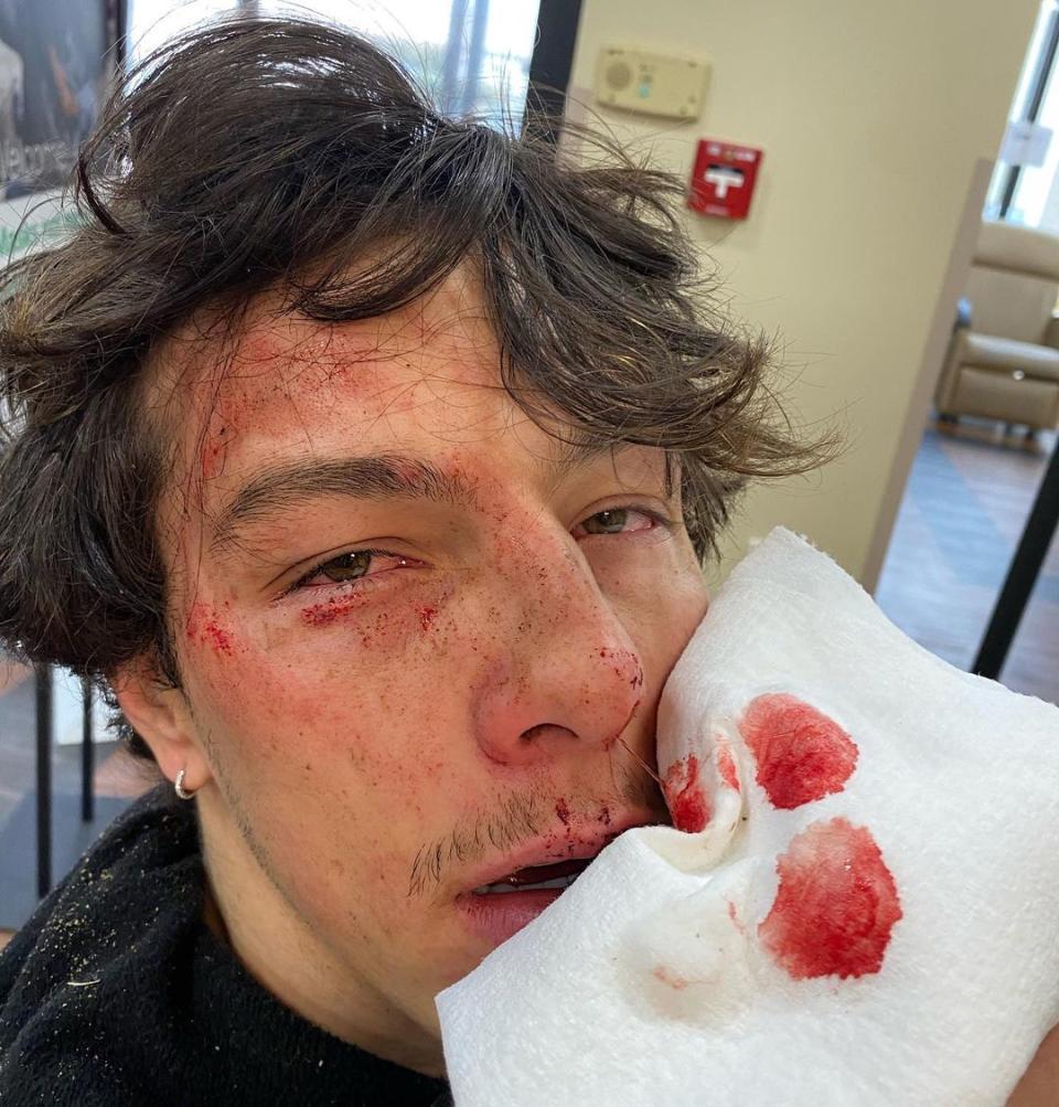 TikTok Star Tayler Holder Hospitalized, Shows Off Bloody Aftermath