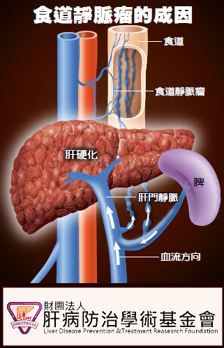 肝硬化後，血液進入肝臟時，因肝門靜脈壓力過大，只好另闢新通道，改走從胃部往上經食道的靜脈，使靜脈壁膨脹曲張宛如腫瘤。