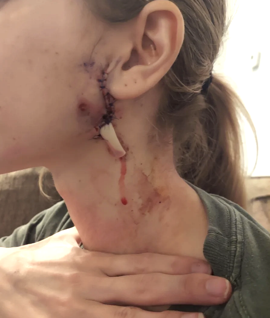 A person with surgical stitches on the side of their face near the ear and neck, with some visible healing wounds and dried blood