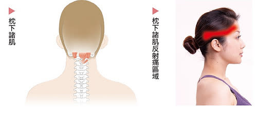 兩側頭痛的相關肌肉及反射痛區域