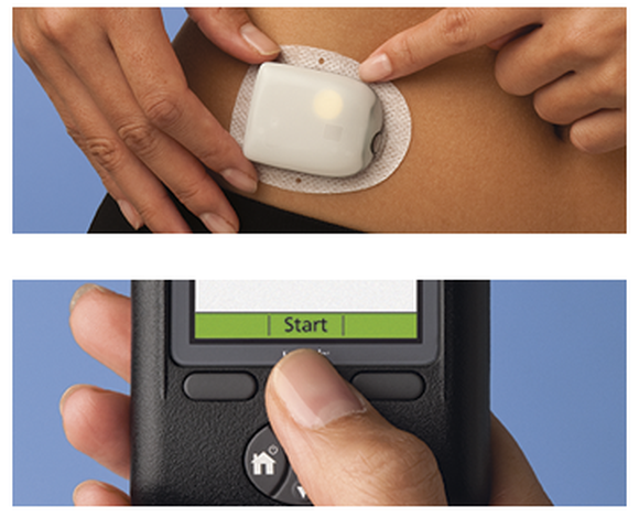 A two-pane panel with upper one showing an Omnipod on a woman's lower stomach and the lower one showing the handheld control device.