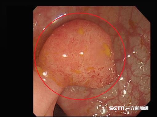 另一名病患的「絨毛管狀腺瘤」。（圖／新竹馬偕醫院提供）