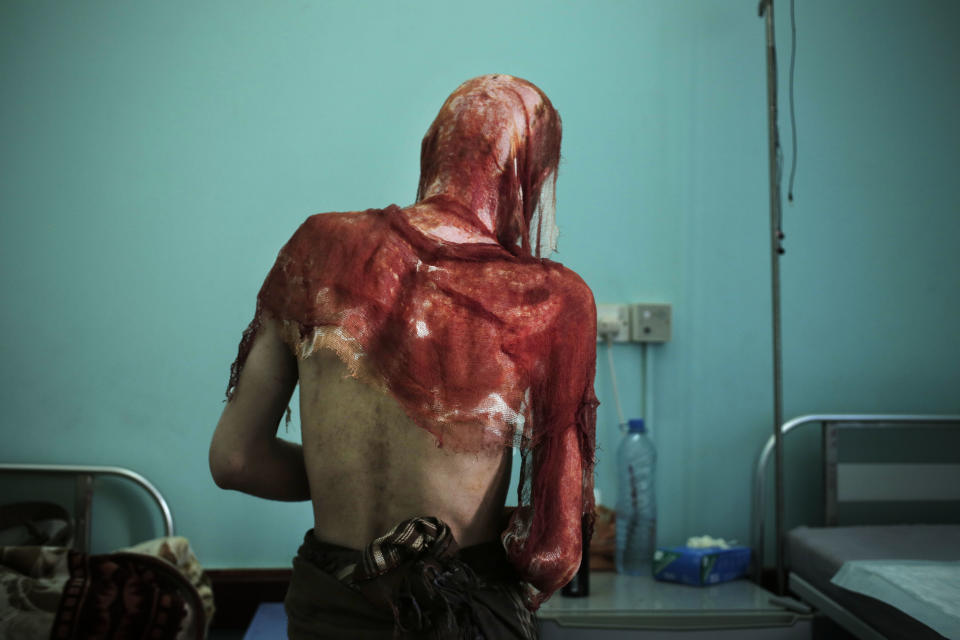 Monir al-Sharqi walks to his bed after nurses changed the dressings on his burns, at the Marib General Hospital in Yemen in this July 25, 2018 photo. Al-Sharqi, a lab technician, disappeared for a year, until he was dumped in a stream, half-naked, emaciated and bearing horrific marks of torture. He had burns from acid over his head, back and shoulders, so severe that his jacket stuck to his melted skin. Some members of his family believe he was detained and tortured by Yemen's Houthi rebels because of his past political activism. (AP Photo/Nariman El-Mofty)
