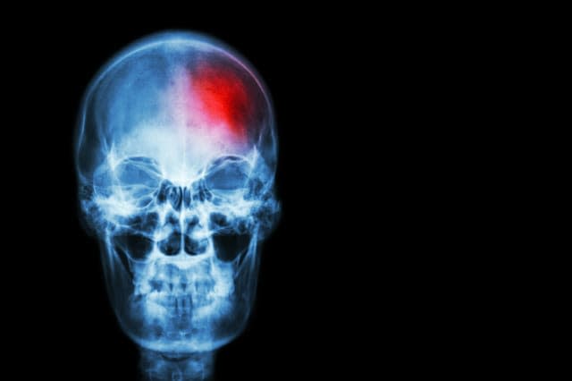 Stroke ( Cerebrovascular accident ) . film x-ray skull of human with red area ( Medical , Science and Healthcare concept and bac
