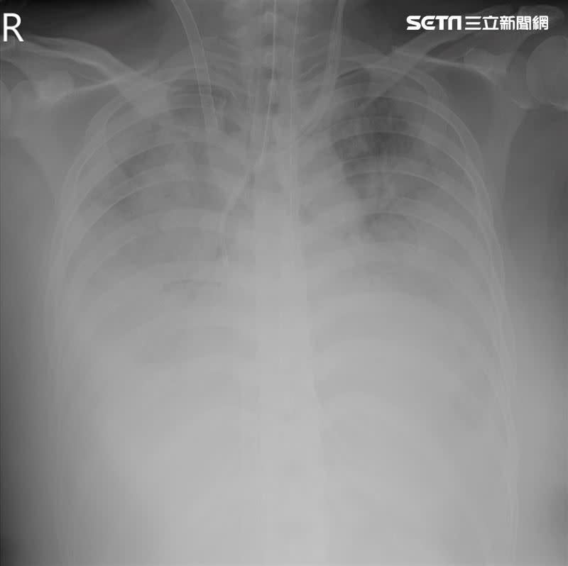 女子因呼吸急促被緊急送醫，X光檢查發現兩肺全白，嚴重缺氧，隨時有生命危險。(圖／烏日林新醫院提供)