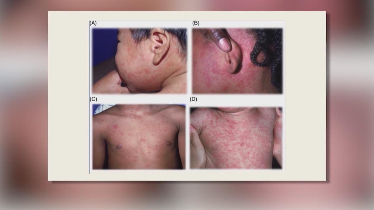 Chicago Health warns of possible measles exposure on CTA buses, city schools