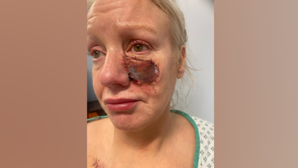 Kelly Allen with an open wound to her face