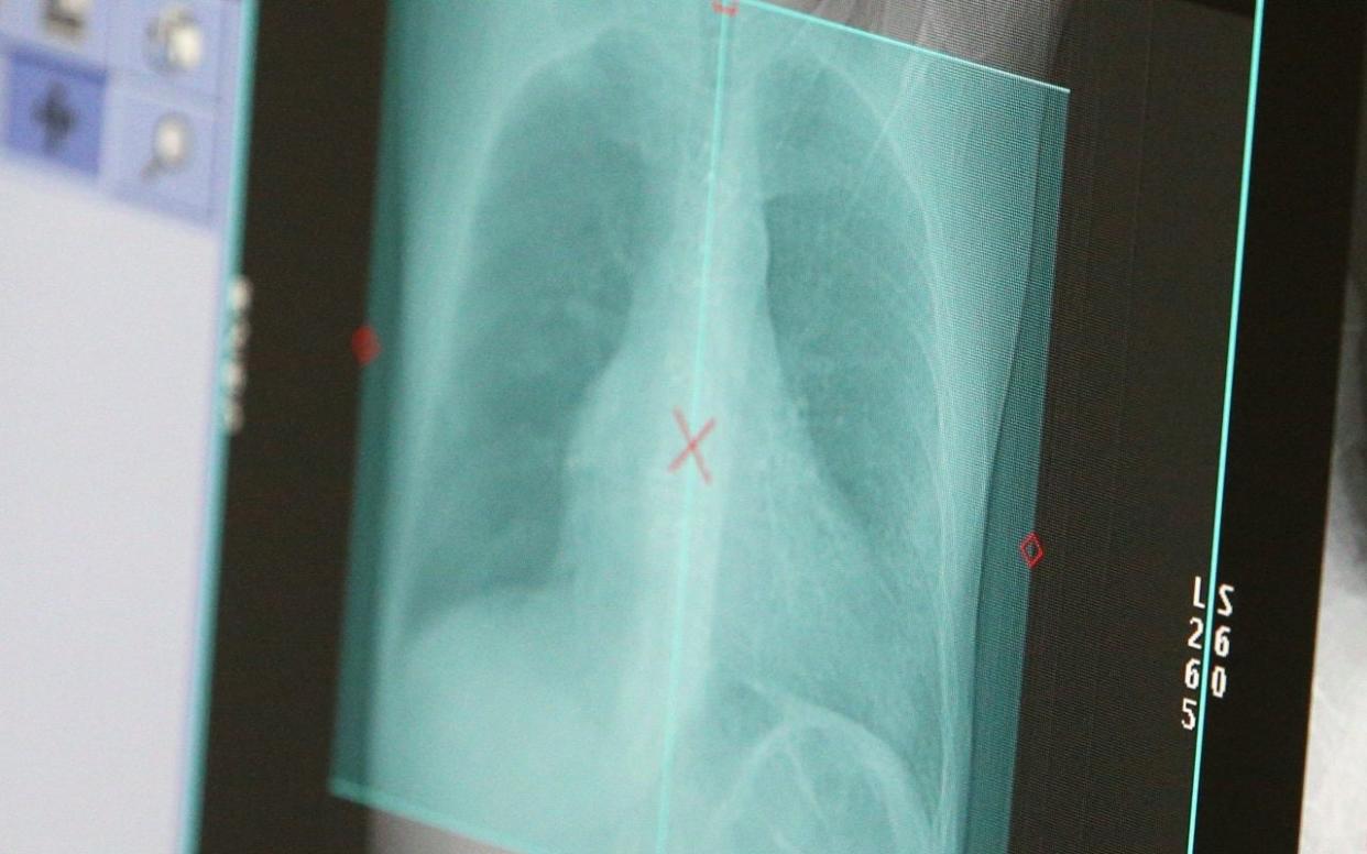 A scan of a patient's lungs from 2020. - Vladimir Gerdo/TASS