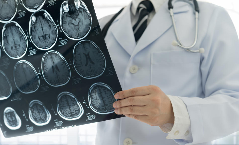 The two-year study included 1,600 patients at hospitals across the country and is the largest stroke clinical trial ever run in Canada. (Photo via Getty Images)