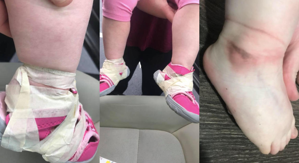 A mum has taken to social media to express her upset that her daughter’s feet were taped at nursery [Photo: Facebook/Jessica Hayes]