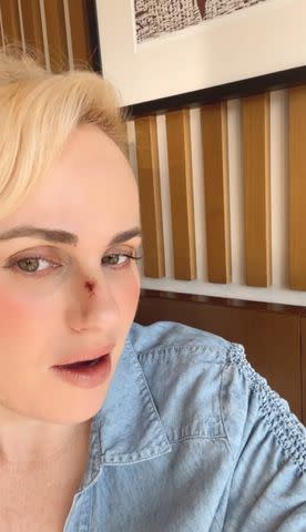 <p>Rebel Wilson Instagram</p> Rebel Wilson shares an update on her health after on set accident last week