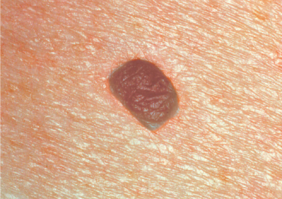A picture of a benign melanoma approaching one-quarter of an inch. (Courtesy The Skin Cancer Foundation)