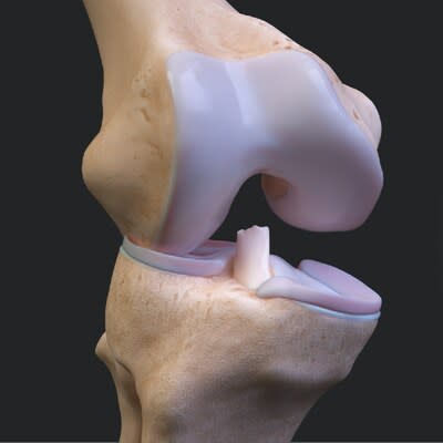 Anterior Cruciate Ligament Tear (ACL Tear) - Sarasota, FL