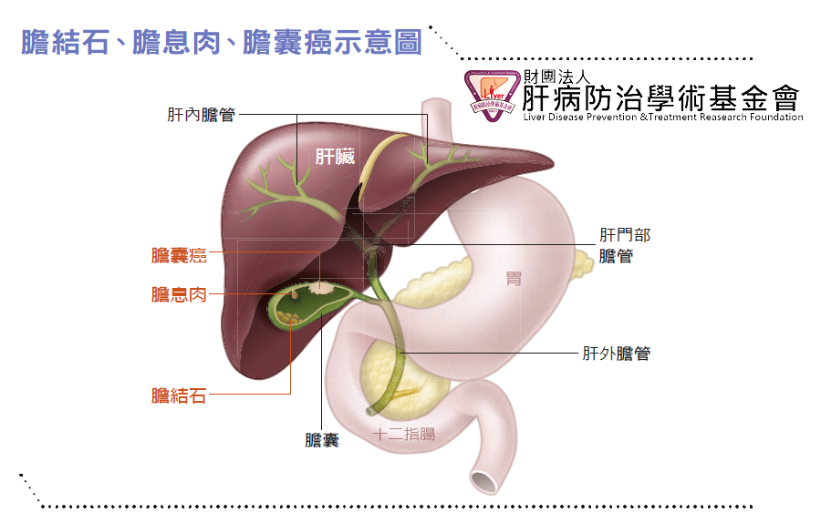 膽結石如果沒有症狀，一般是不需要治療的。