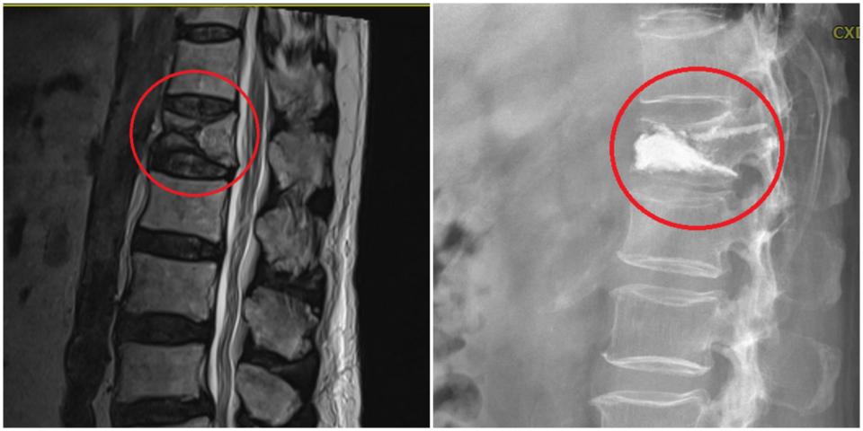 術前核磁共振影像顯示，腰椎第一節呈現壓迫性骨折。術後X光顯示，水泥注入椎體骨折處，增強椎體強度及脊椎穩定性。