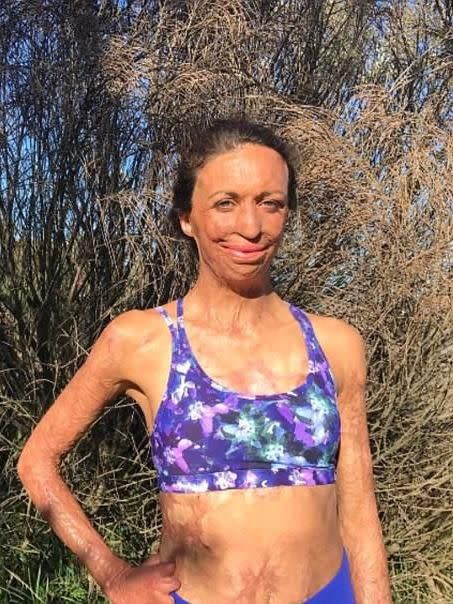 She suffered burns to 65% of her body in 2011. Source: Instagram/turiapitt