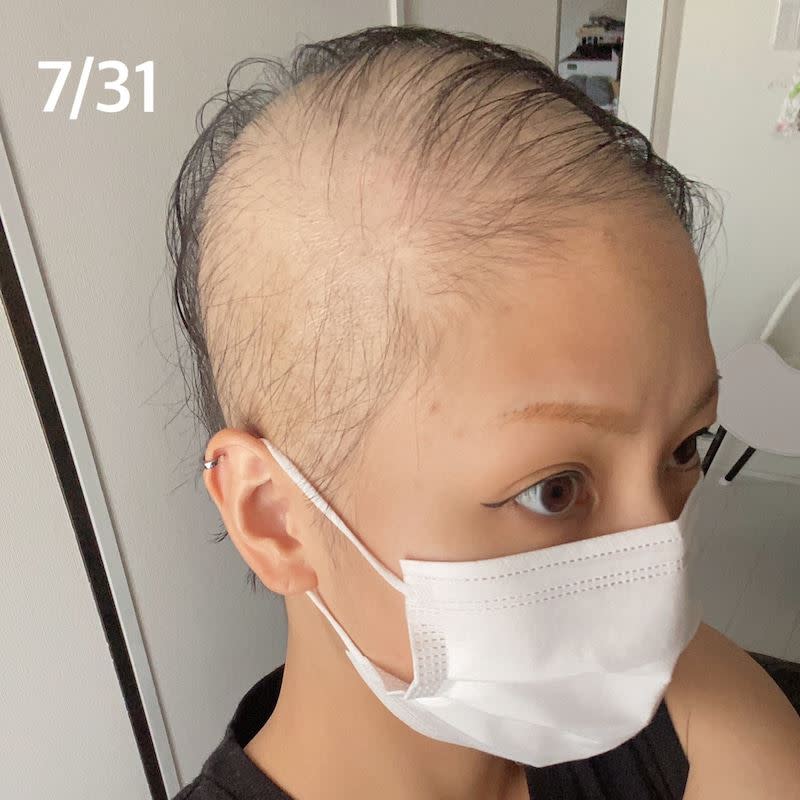 日本女網友接種莫德納疫苗後出現嚴重脫髮的狀況。（圖／翻攝自ayapipipiii Ameba）