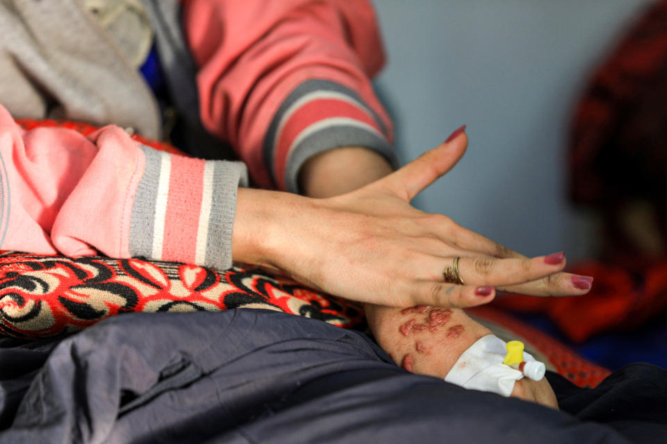 EDITORS NOTE: Graphic content / Al-Anoud Hussain Sheryan, a 19-year-old girl disfigured in an acid attack by her abusive husband, holds her hands together as she sits at a hospital where she is undergoing treatment in Yemen's capital Sanaa on January 28, 2021. - Married at the age of 12, rejected at 16, and then disfigured in an acid attack, Sheryan's fate is a shocking illustration of abuse in a society beset by war and poverty. Now aged 19, the young Yemeni woman agreed to relate her ordeal at the hands of her abusive husband -- rare testimony in a country where domestic violence is largely hidden. (Photo by Mohammed HUWAIS / AFP) (Photo by MOHAMMED HUWAIS/AFP via Getty Images)