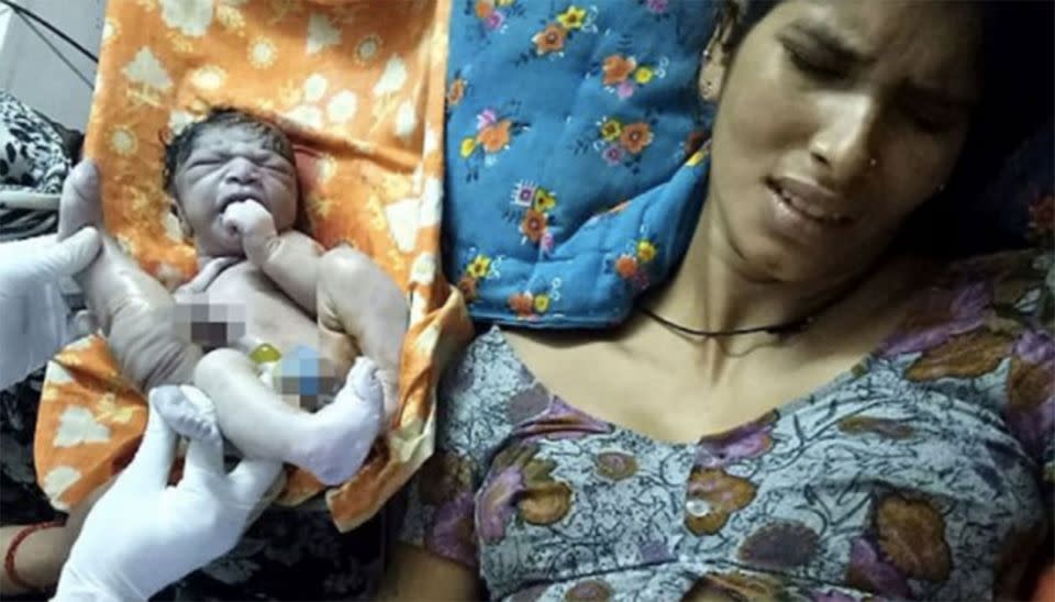 Kuli Bai, 22, gave birth to a boy with a parasitic twin in a northern Indian village. Source: CoverAsia Press.