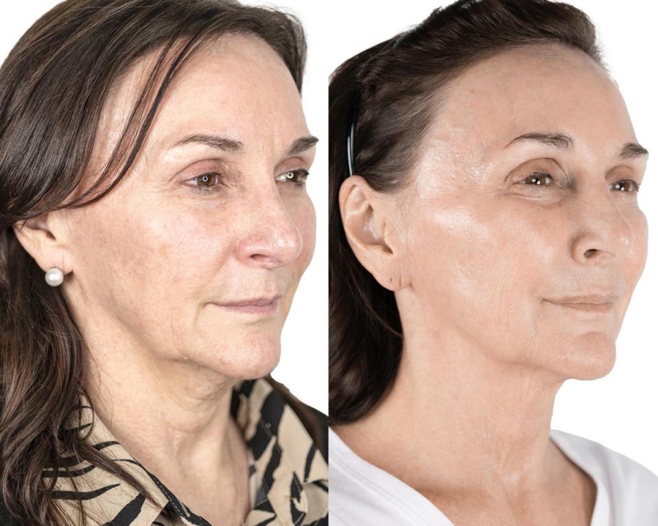 Shirley Ballas  seen before and after the non-surgical face lift (ES)