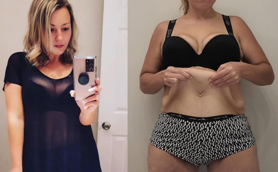 柯西沒想到雖然成功減肥，身上卻留有嚴重的贅皮，影響到她生活行動跟性生活。（翻攝IG@scarleycat86、Go Fund Me）