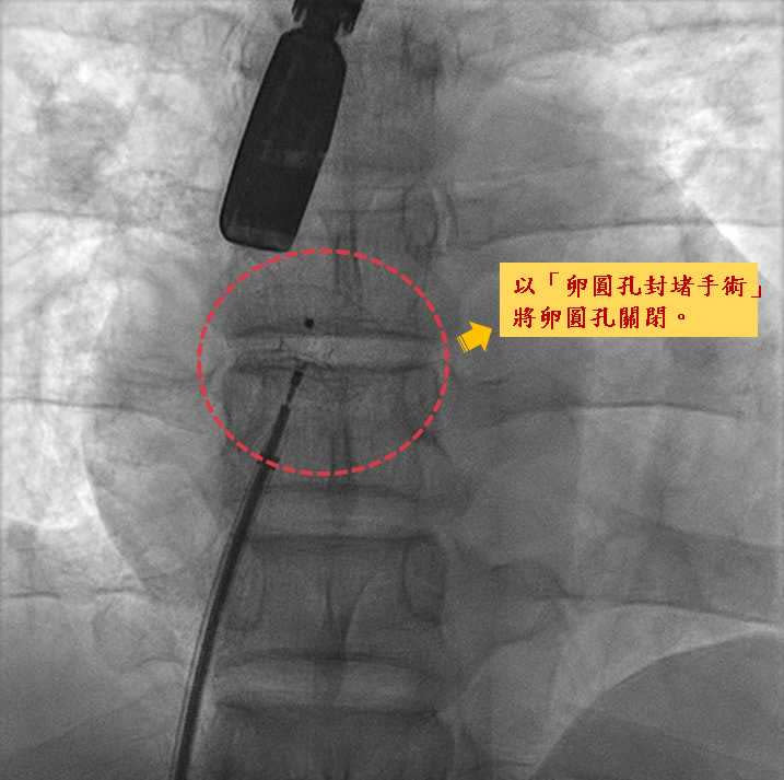 經過腦部核磁共振檢查後，發現男子腦中風的原因竟是心臟的「卵圓孔閉鎖不全」。（圖／中國醫藥大學新竹附設醫院）