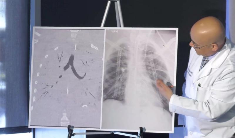 Los médicos en Detroit realizaron el primer trasplante de doble pulmón en un paciente con una enfermedad relacionada con el vapeo. Durante una conferencia de prensa ofrecida el martes, el doctor Hassan Nemeh mostró una imagen de los pulmones dañados y los nuevos. (Foto, Facebook: Sistema de salud del Henry Ford)