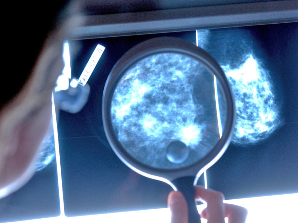 A doctor examines a mammograph of a breast cancer patient: Rex Features