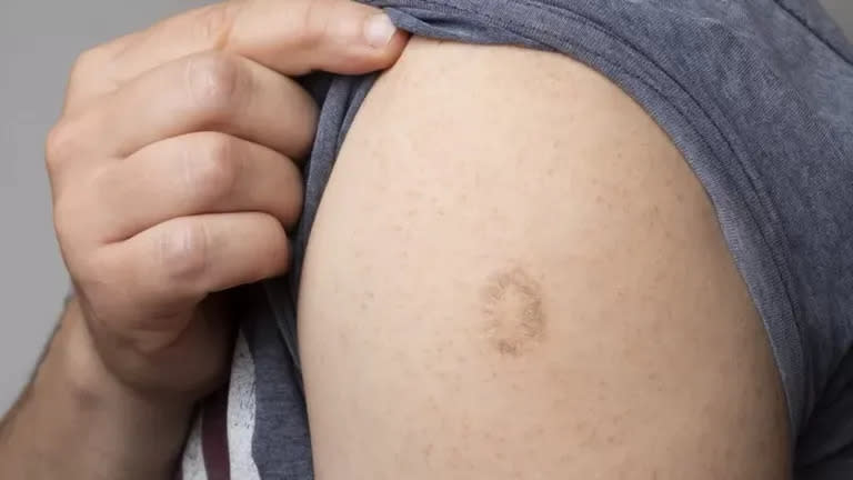 La vacuna contra la viruela deja una pequeña cicatriz.