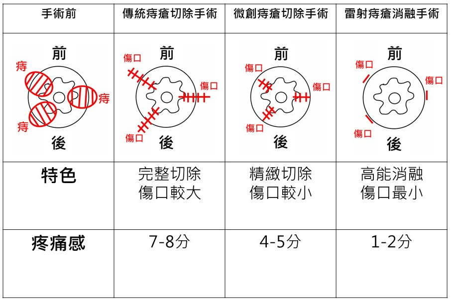 亞東醫院提供各式痔瘡手術特色及疼痛感比較表。（亞東醫院提供）