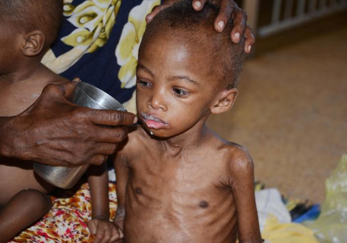 A malnourished child receives a drink in Banadir Hospital in Mogadishu on May 20, 2014. (AFP Photo/Mohamed Abdiwahab)