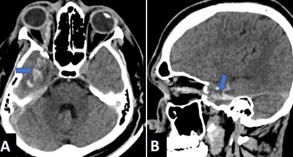 A CT scan shows the head of a man stabbed in the eye with an ice pick.