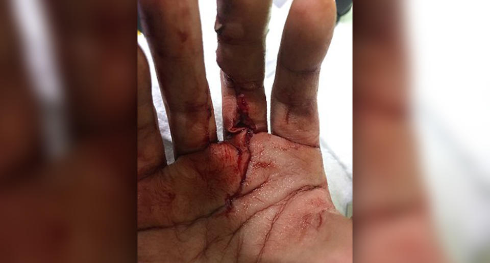 Sarah sliced open her hand after falling on a sharp rock. Source: Brian Coulter/Saltwater Ecology