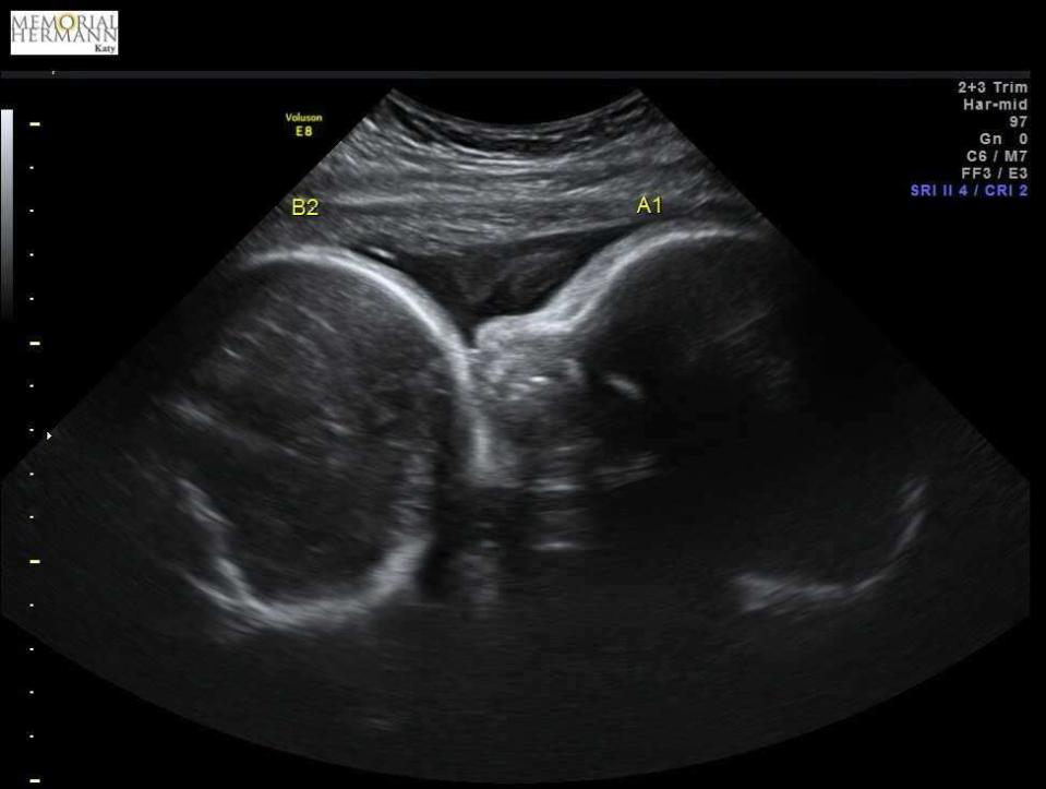 An ultrasound photo  in January 2018.